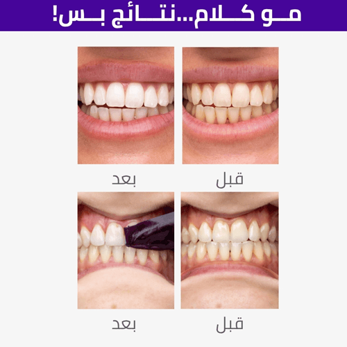 Hismile V34 Teeth Whitening Strips - 73904